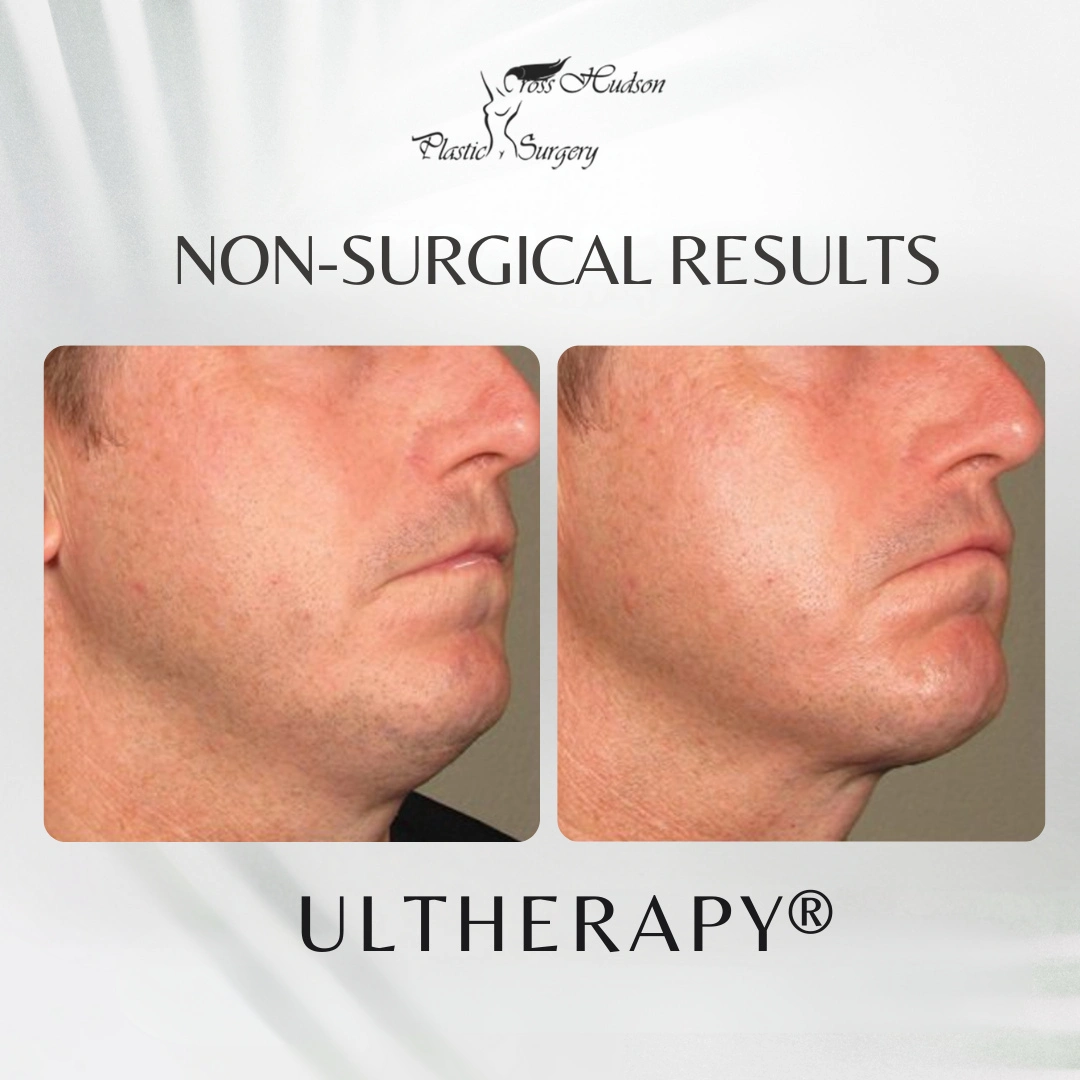 Before and after profile view of a patient's jawline and neck showing improved definition and skin tightness following Ultherapy treatment